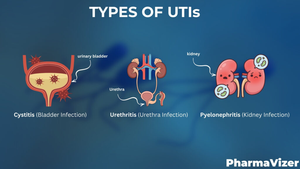 Diagram showing different types of (UTIs) urinary tract infections including urethritis, cystitis, and pyelonephritis.