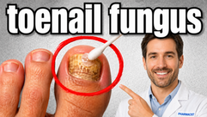 What Kills Toenail Fungus Instantly?