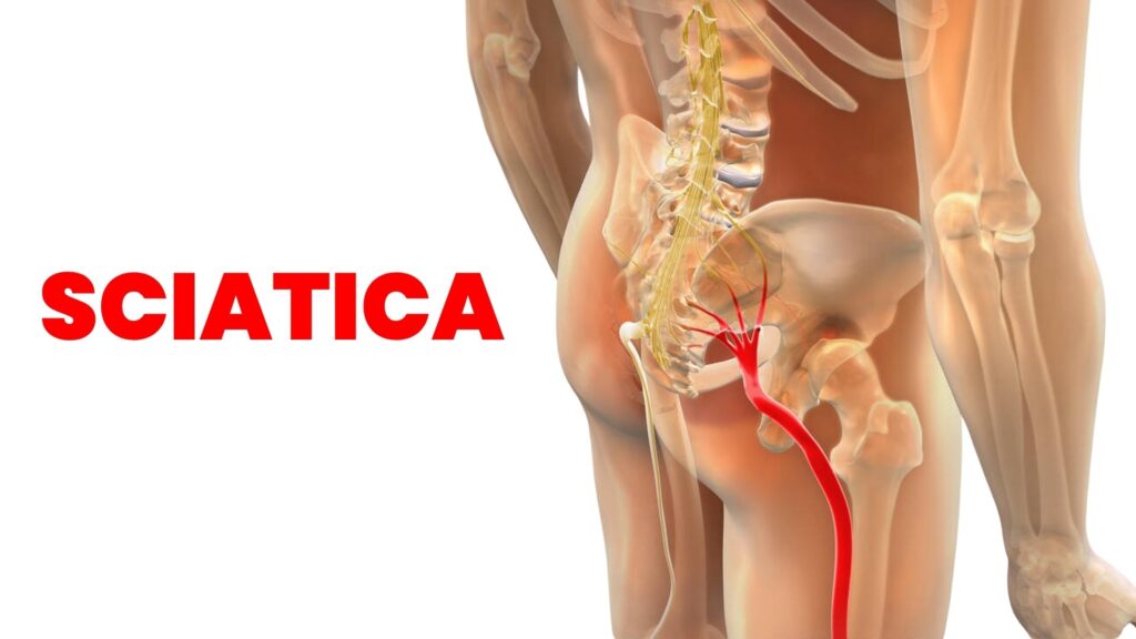 SCIATICA PAIN
