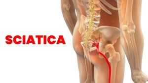SCIATICA PAIN