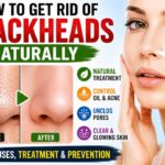 How to Get Rid of Blackheads Naturally